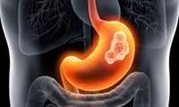 برگزاری   Tumor Board Gastric Cancer